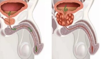 Prostatitis